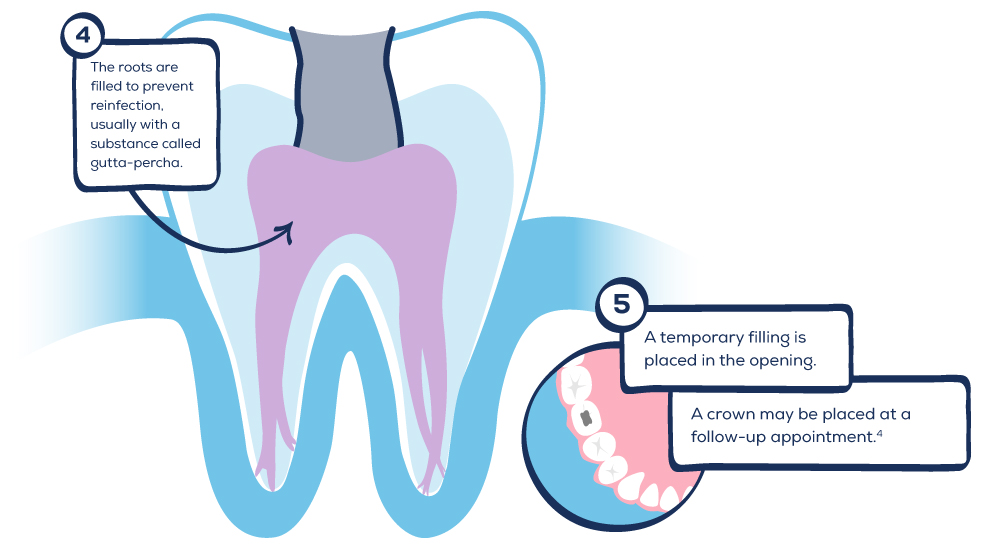 What to Expect from Root Canal Treatment GentleWave® Procedure